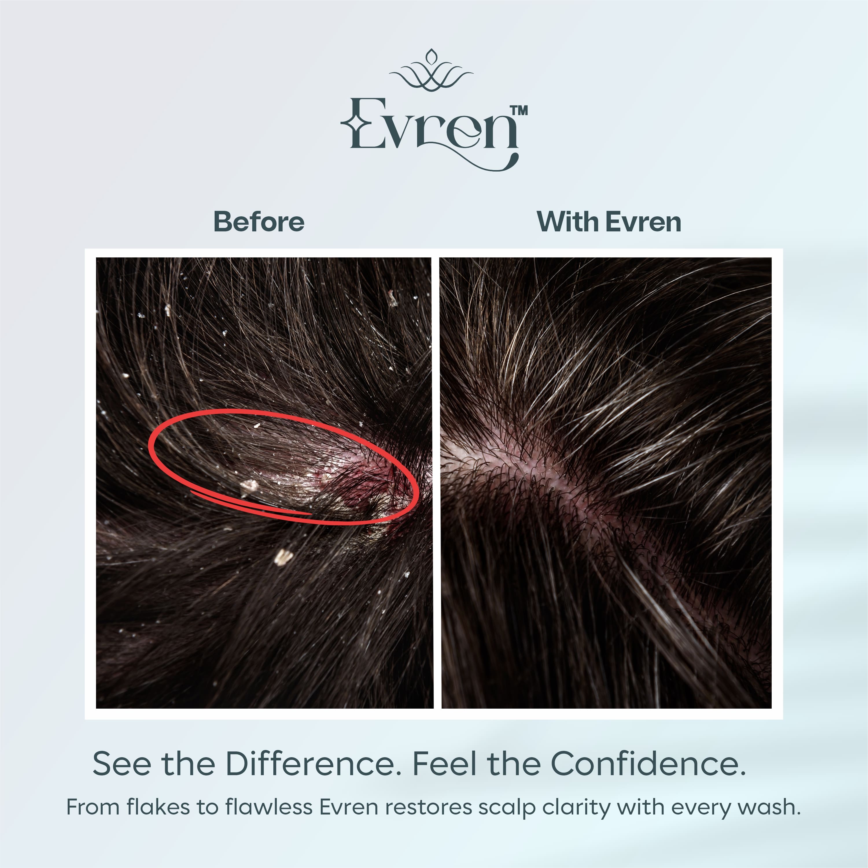 Ultimate Anti Dandruff Kit