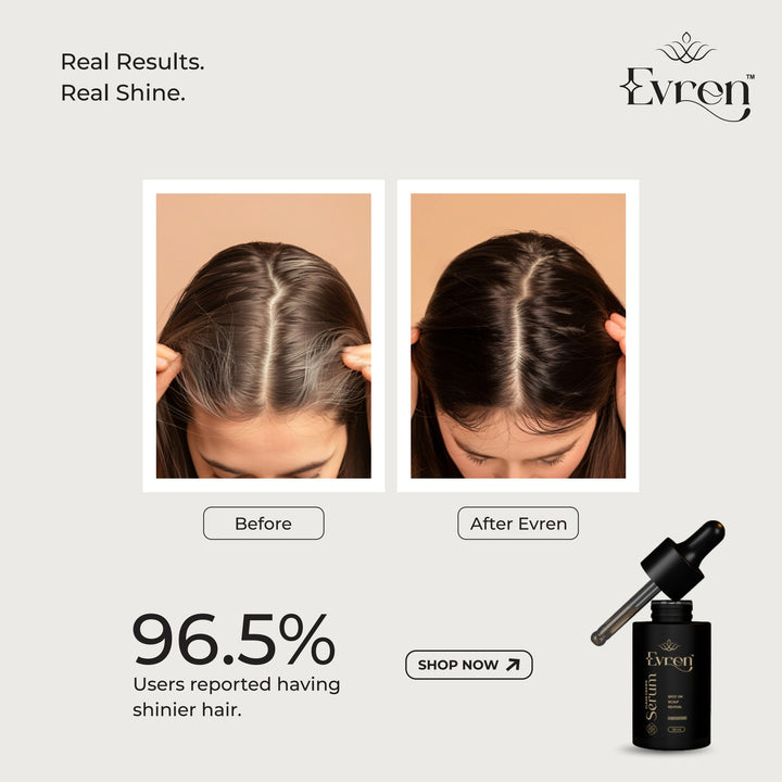 Anti-Dandruff Serum | Controls Flakes, Balances Sebum & Restores Scalp Health